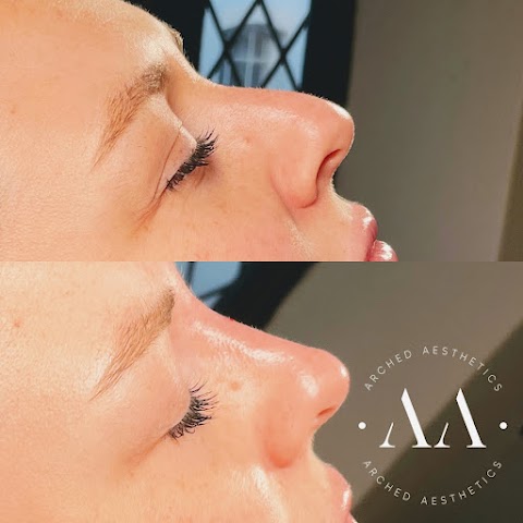 Arched Aesthetics | Aesthetic Treatments & Lip Fillers Plymouth
