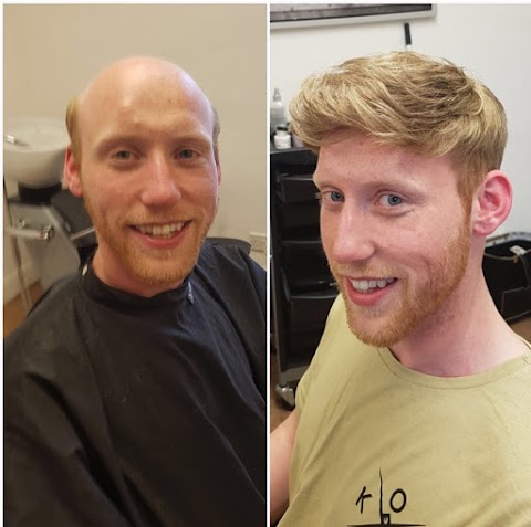 Leicester Hair Loss Clinic