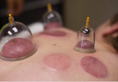 Hijama cupping manchester for women only