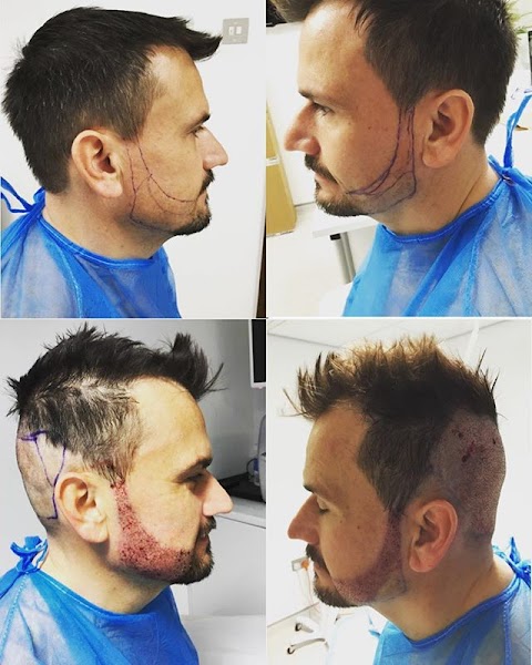 UK Hair Transplant Clinics Belfast