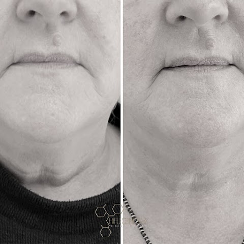 HIFU Clinics UK - Non Surgical Facelift - Non Surgical Lipo - HIFU Training - Plasma Treatments - Profhilo