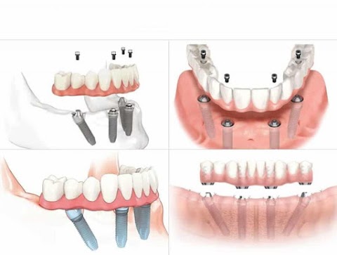 Tareq Ahmado - Master Sci in Dental Implants