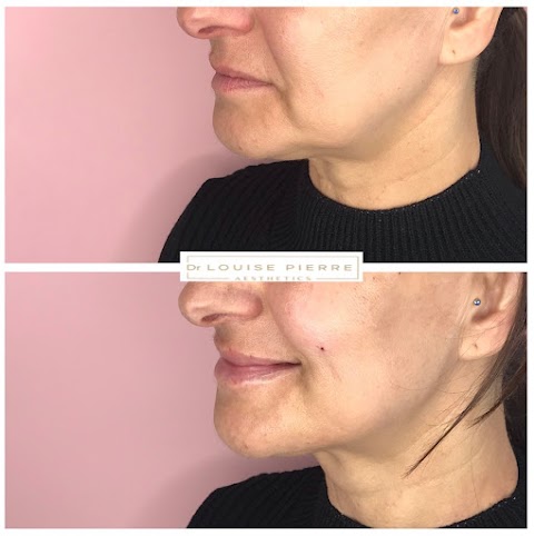 Dr Louise Pierre Aesthetics | Lip Fillers | Anti Wrinkle | Facial Aesthetics Treatments