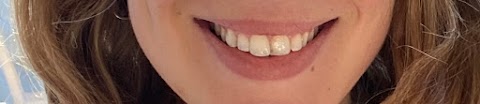 Natural White | Teeth Whitening & Veneers