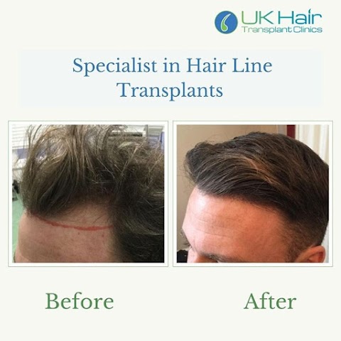 UK Hair Transplant Clinics Belfast