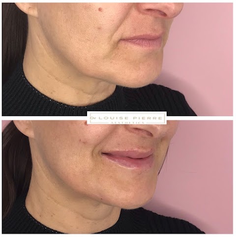 Dr Louise Pierre Aesthetics | Lip Fillers | Anti Wrinkle | Facial Aesthetics Treatments