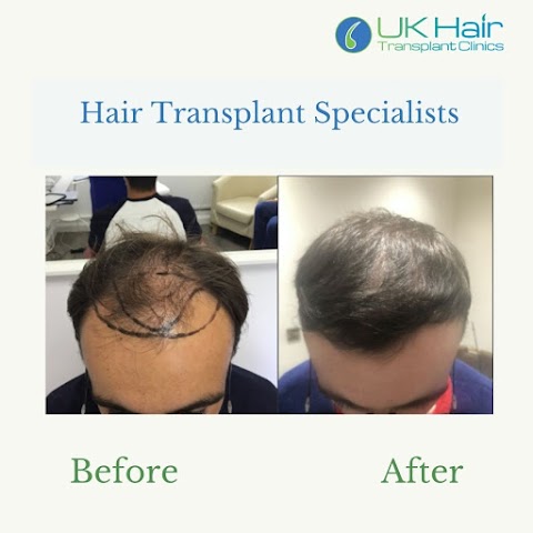 Uk Hair Transplant Clinics Nottingham