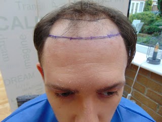 Better Hair Transplant Clinics