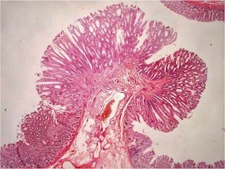 Family History of Bowel Cancer Clinic