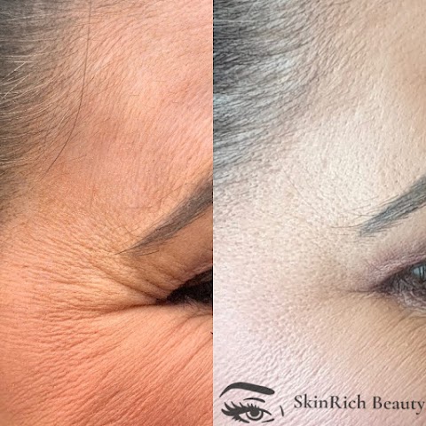 SkinRich Beauty - Lip Fillers - Anti Wrinkle Treatments - Dermaplaning - Fat Dissolving Injections - Microneedeling