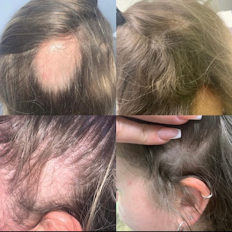 Leicester Hair Loss Clinic