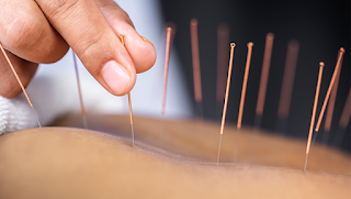 Glenfield Acupuncture