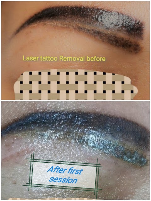 Cheadle Laser Clinic - Laser Hair Removal I HIFU I Tattoo Removal I Carbon Peel