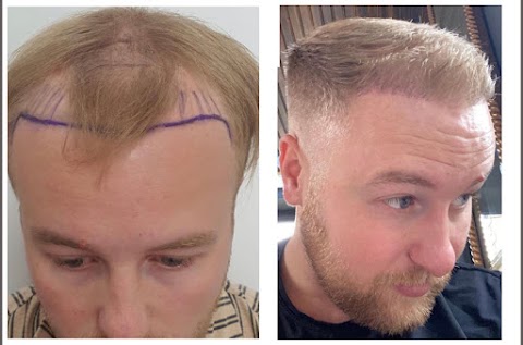 Leeds Hair Loss Clinic