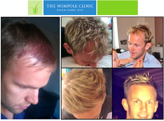 Wimpole Hair Transplant Clinic Bristol