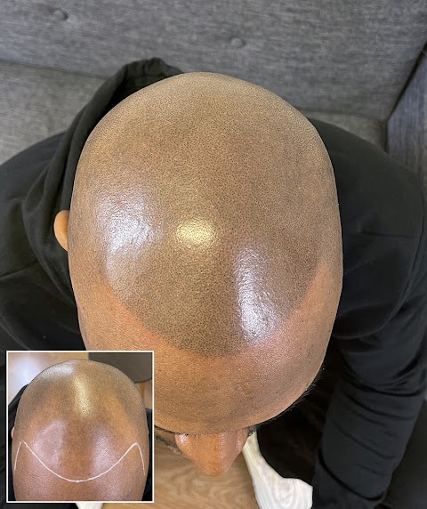 Skalp | Dublin Scalp Micropigmentation Clinic