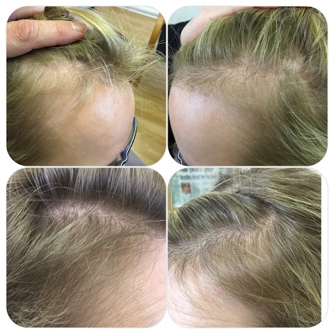 Leicester Hair Loss Clinic