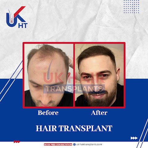 UK Hair Transplants UKHT Hair Loss Clinic - Birmingham - Walsall - Leicester - West Midlands