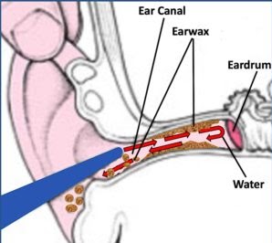 Ear Wax Removal NHS Accredited