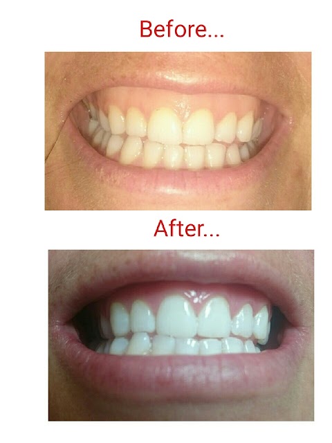 Yorkshire Laser Teeth Whitening, Hair Removal & IPL, Laser Tattoo Removal