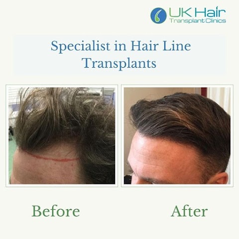 Uk Hair Transplant Clinics Nottingham