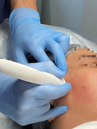 Harrow Microneedling Clinic - Affordable Microneedling Specialist