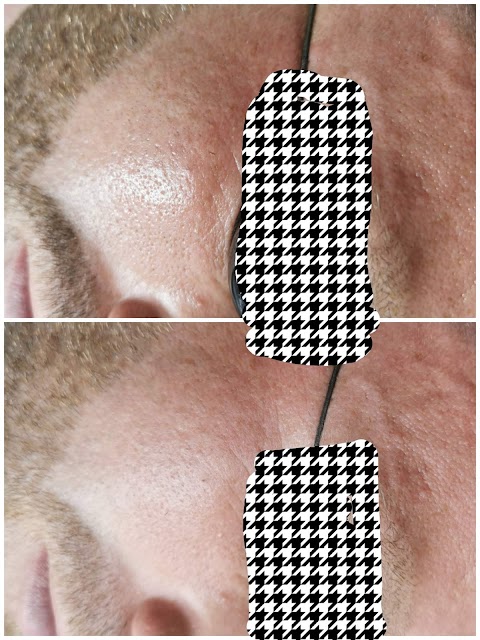 Cheadle Laser Clinic - Laser Hair Removal I HIFU I Tattoo Removal I Carbon Peel