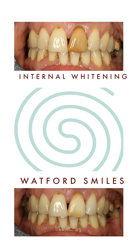 Watford Smiles Invisalign