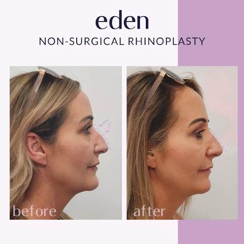 Eden Medical Belfast - Dermal filler, Anti wrinkle, Lip filler, Cheek, Jawline, Belfast