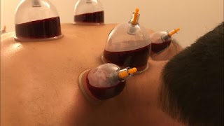 Cupping Clinic Yorkshire