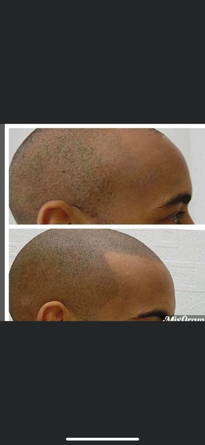 FreMat SMP Clinic (Scalp Micropigmentation Clinic