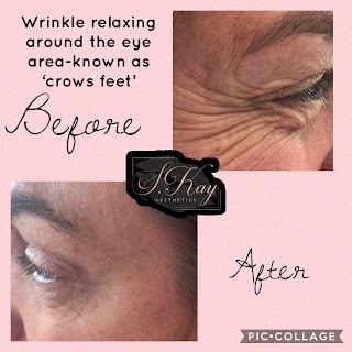 S Kay Aesthetics- Dermal Fillers, Wrinkle Relaxation