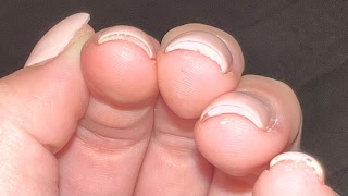 L1 Nails