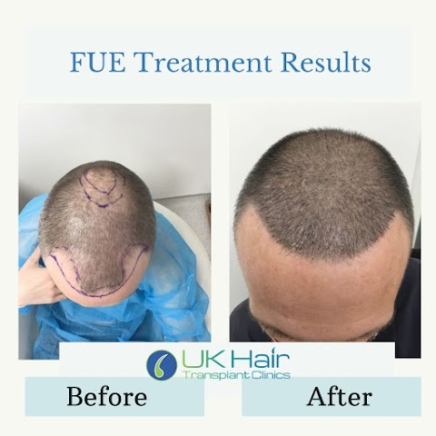 UK Hair Transplant Clinics Belfast