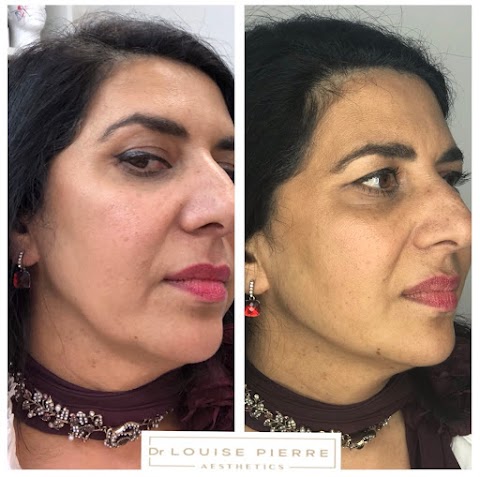 Dr Louise Pierre Aesthetics | Lip Fillers | Anti Wrinkle | Facial Aesthetics Treatments