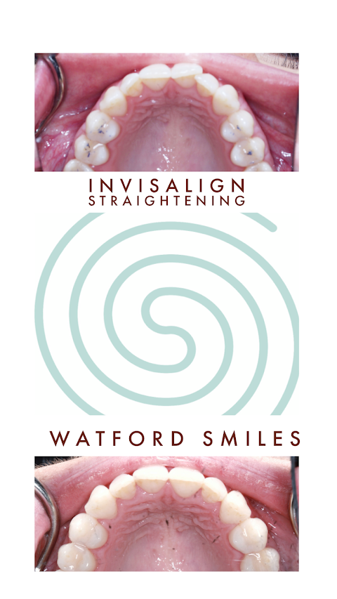 Watford Smiles Invisalign