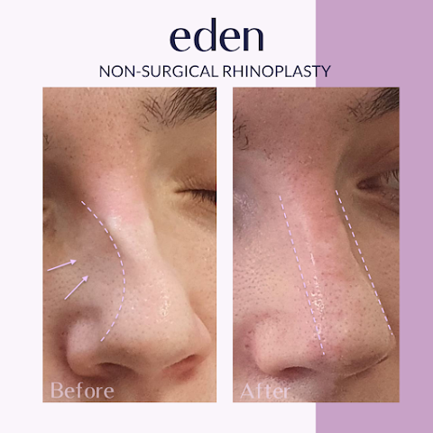 Eden Medical Kilkenny - Dermal filler, Lip filler, Anti wrinkle, Cheek filler, Jawline filler Kilkenny