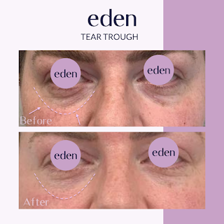 Eden Medical Kilkenny - Dermal filler, Lip filler, Anti wrinkle, Cheek filler, Jawline filler Kilkenny