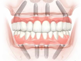 Dr Giza - implanty zębów, periodontolog, chirurgia stomatologiczna