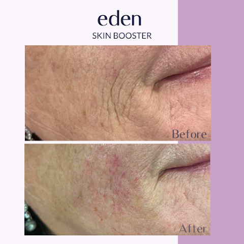 Eden Medical Kilkenny - Dermal filler, Lip filler, Anti wrinkle, Cheek filler, Jawline filler Kilkenny