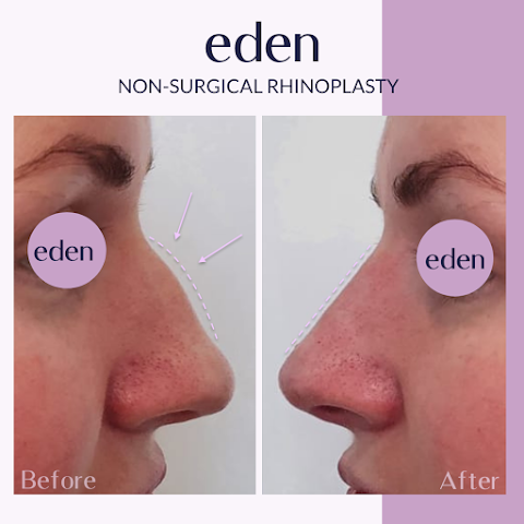 Eden Medical Kilkenny - Dermal filler, Lip filler, Anti wrinkle, Cheek filler, Jawline filler Kilkenny