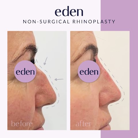 Eden Medical Kilkenny - Dermal filler, Lip filler, Anti wrinkle, Cheek filler, Jawline filler Kilkenny