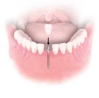 Dental Implant Solutions Lawton, OK