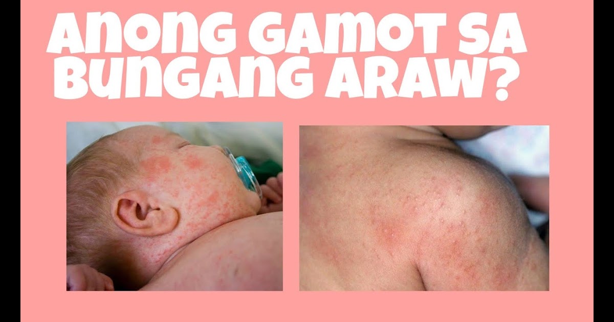 Ano Ang Gamot Sa Bungang Araw Ng Sanggol