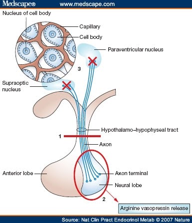 diabetes insipidus labor lexikon