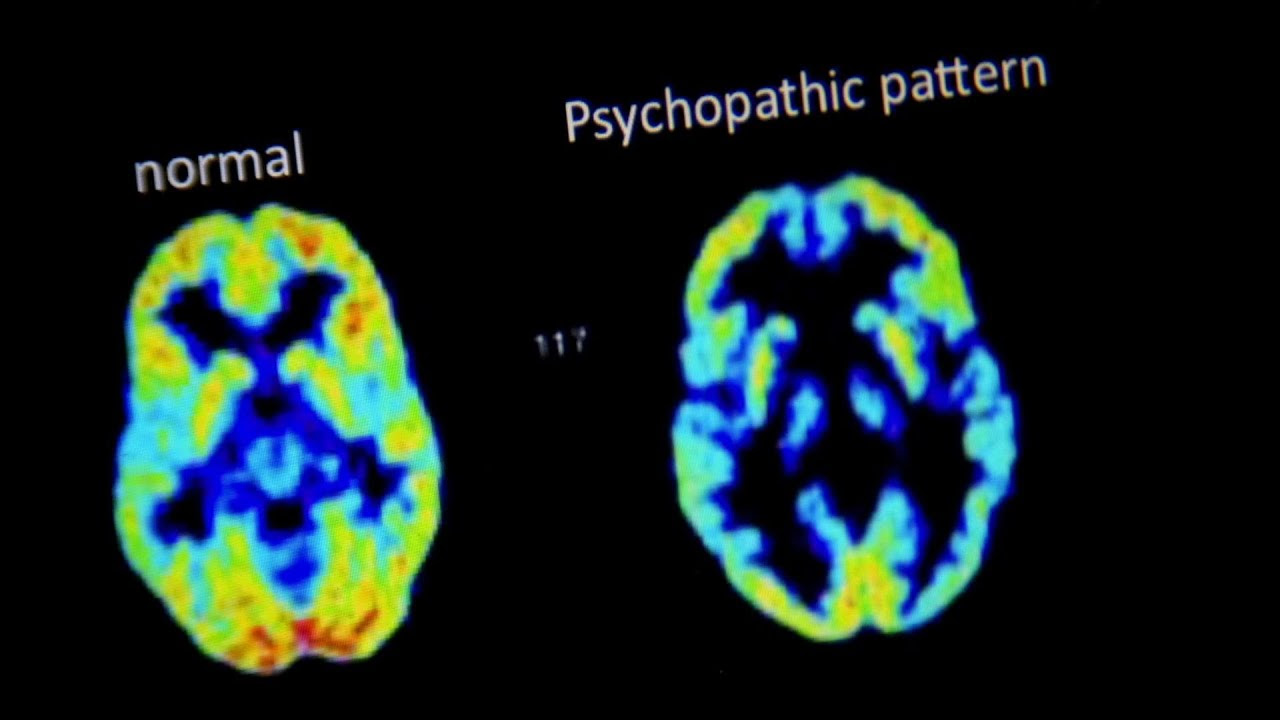 More Brain Points: You should be a psychopath