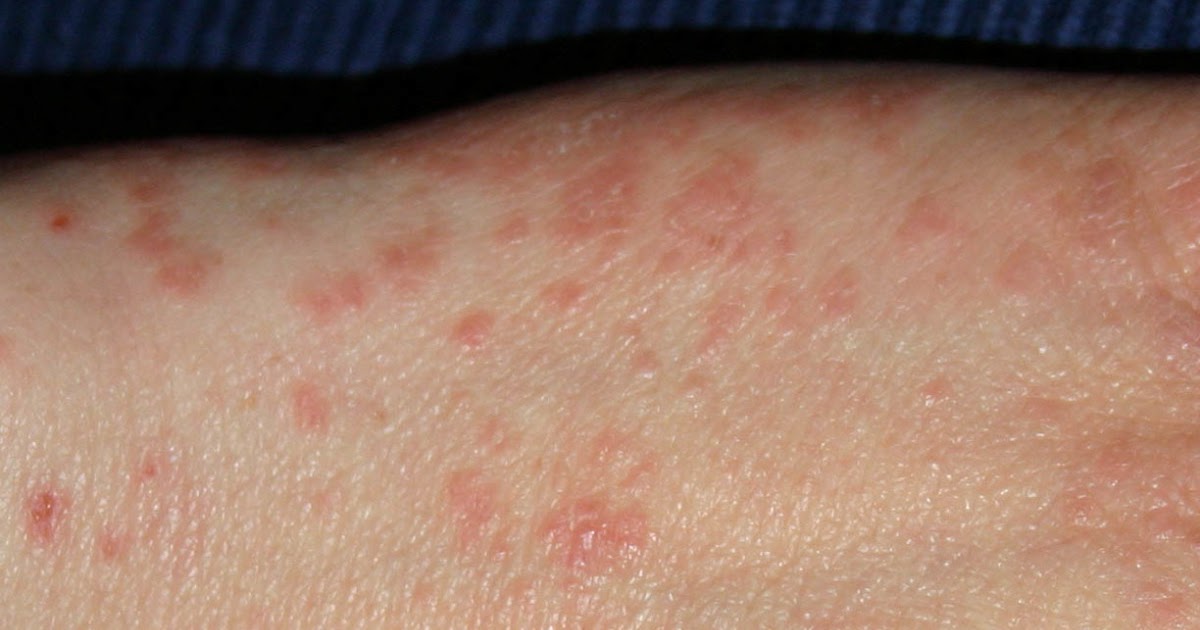 Pinprick Red Dots On Skin Itchy Terrifying Photos Show Deadly