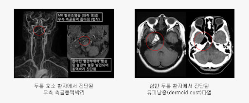두통 MRI를 찍어야 하나? 뒷목통증 원인과 치료법을 찾고 계시다면 2