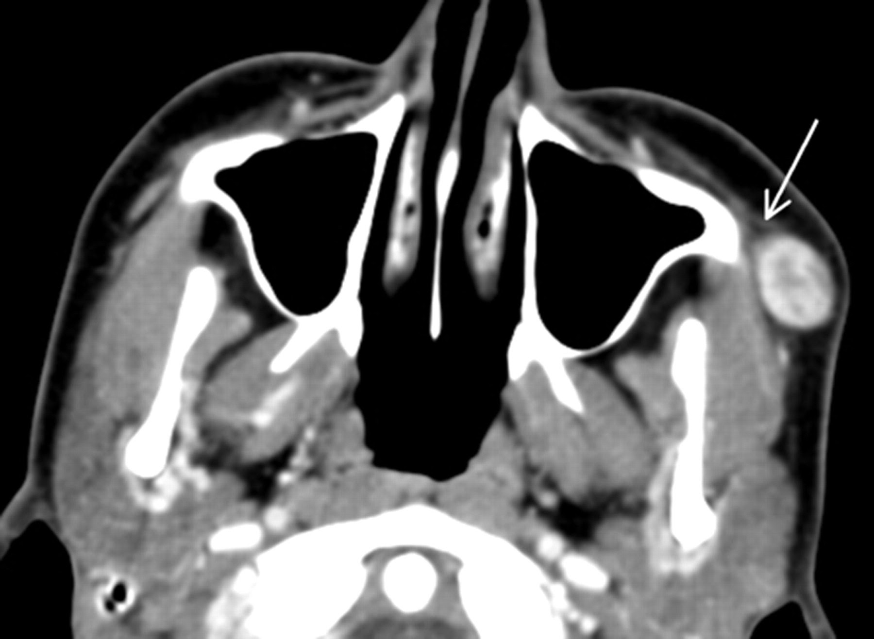 What Does A Soft Tissue Neck Ct Scan Show Ct Scan Machine