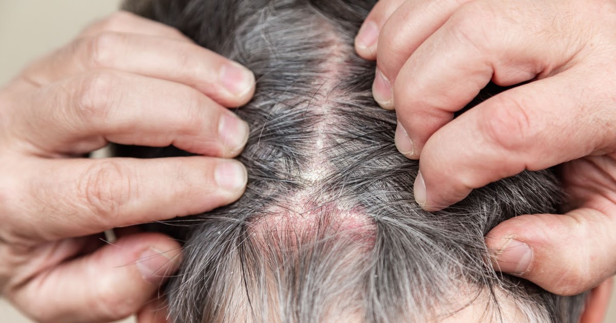 Scabs On Scalp Causes Diagnosis And Treatment Verywell Health